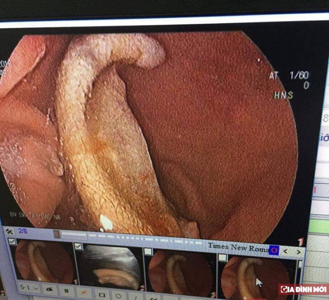   Kết quả nội soi cho thấy vành tai nằm gọn trong ổ bụng  