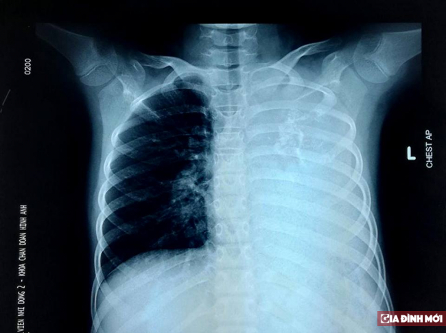   Hình ảnh khối u ở phổi trái bé gái  