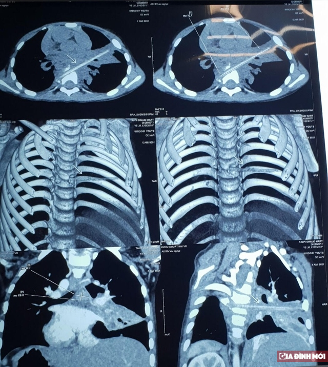   Hình ảnh cho thấy thuỳ phổi phải của cháu bé có dị vật  
