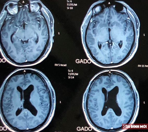   Hình ảnh khối u xâm lấn ngay trung tâm não của bệnh nhân  