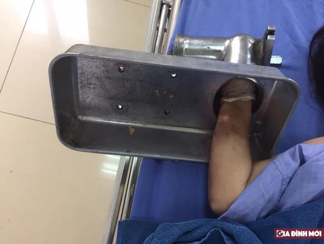 Bị cuốn cả bàn tay vào máy xay thịt, nữ bệnh nhân bị cắt cụt nhiều ngón tay 0