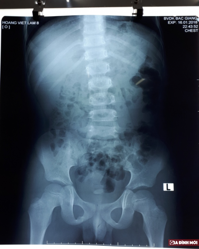   Hình ảnh chụp hệ tiết niệu của trẻ 8 tuổi trước khi tiến hành phẫu thuật  