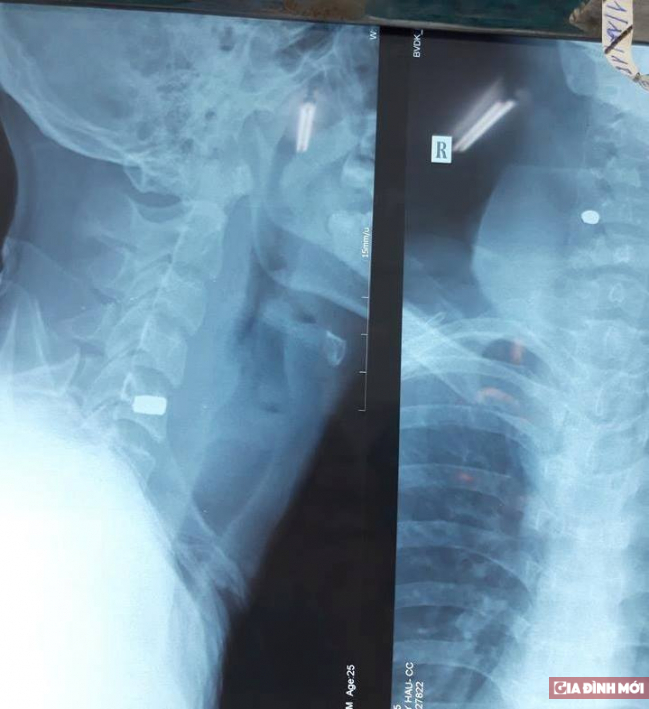   Hình ảnh X.quang cho thấy viên đạn nằm sâu trong cổ  