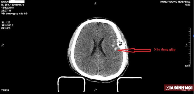 Bị tai nạn giao thông, nam bệnh nhân dập não, vỡ lún xương sọ 0