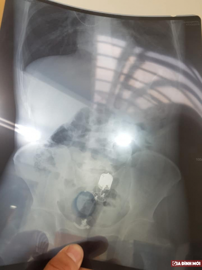   Hình ảnh chụp phim cho thấy có dị vật ở trong trực tràng bệnh nhân  