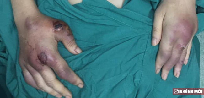   Bàn tay của cô gái 25 tuổi biến dạng sau tiêm mỡ nhân tạo tại một spa, cơ sở thẩm mỹ viện thiếu uy tín  