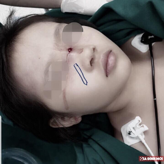   Bé gái bị tai nạn hy hữu, ngòi bút chì đâm xuyên sống mũi  