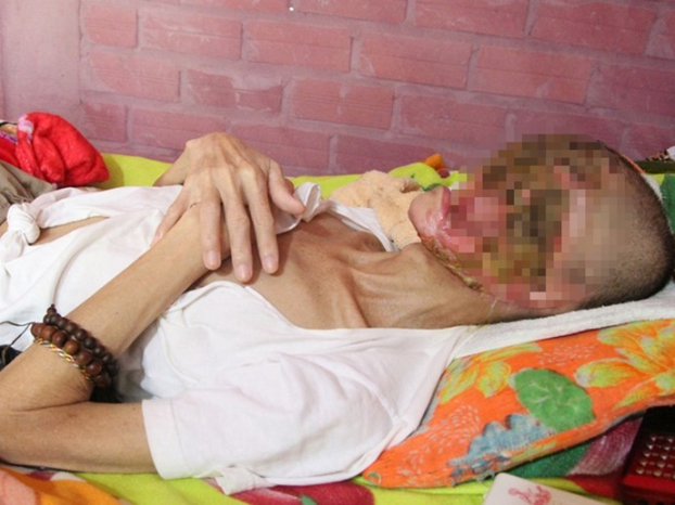   Một trong số bệnh nhân hiếm hoi bị mắc cam tẩu mã ở Việt Nam với khuôn mặt gần như biến dạng do không chạy chữa  
