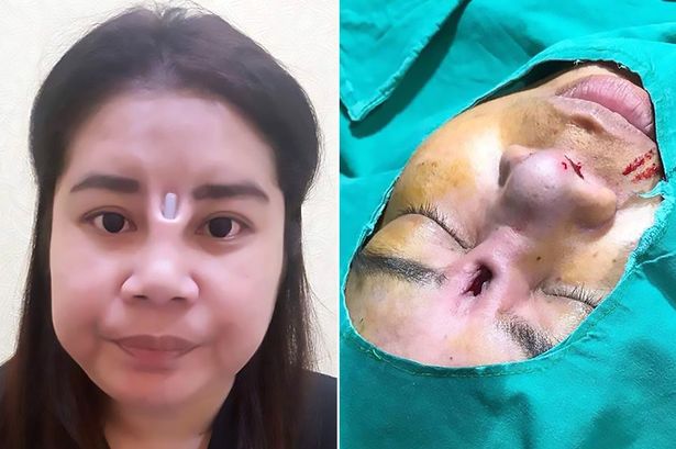 Một trường hợp người phụ nữ Thái Lan thẩm mỹ mũi, kết quả silicone trồi lên sống mũi cách đây không lâu.