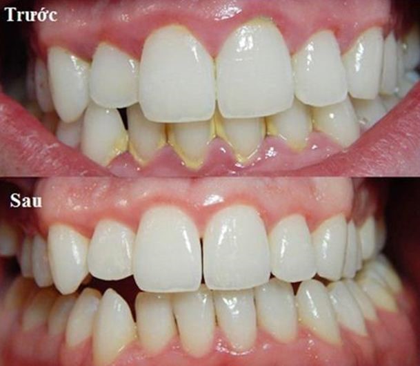   Làm sạch mảng bám, hạn chế vi khuẩn sẽ giúp khoang miệng thơm tho, hàm răng trắng sạch.  