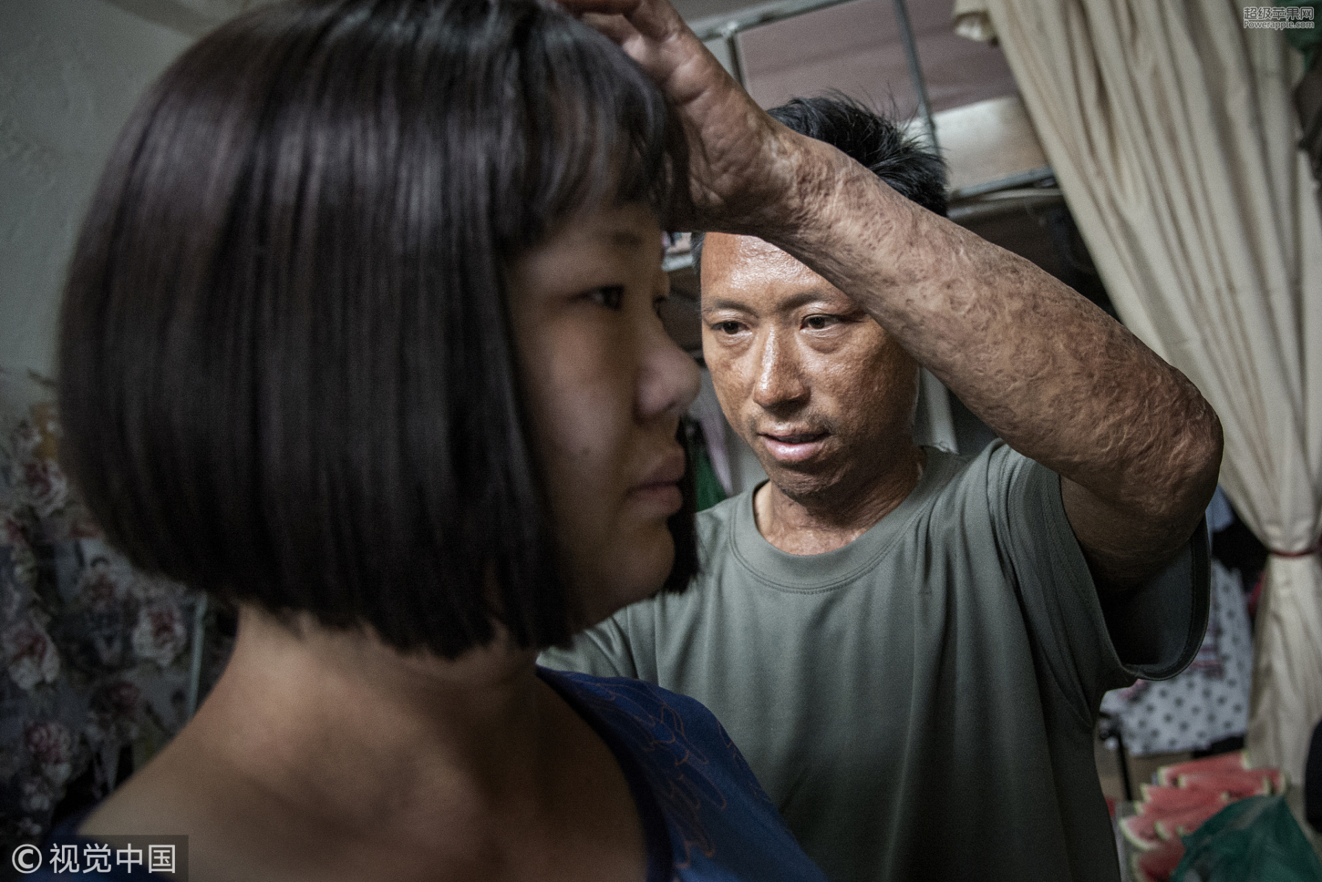Người chồng bỏng nặng rơi nước mắt khi vợ cắt trọc tóc vì một lý do 5