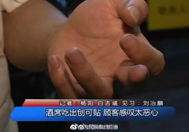   Quả thực nhân viên này đã dán một miếng urgo lên vết thương ở ngón tay.  