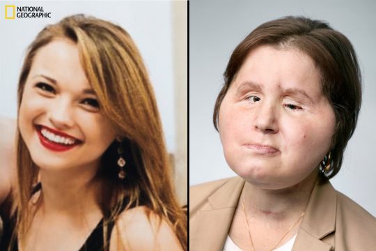 Katie trước khi tự tử (trái) và sau khuôn mặt sau khi được phẫu thuật (phải) - Ảnh: National Geographic