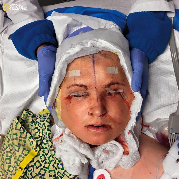 Sau 31 giờ phẫu thuật, đầu của Katie được cố định, mắt cô cũng được dán băng dính để tránh tổn thương - Ảnh: National Geographic