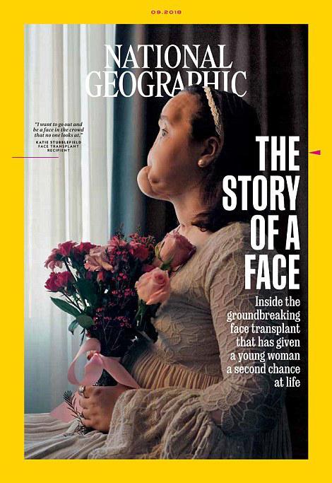 Gương mặt biến dạng hoàn toàn của cô gái trẻ trước khi tiến hành phẫu thuật cấy ghép - Ảnh: National Geographic