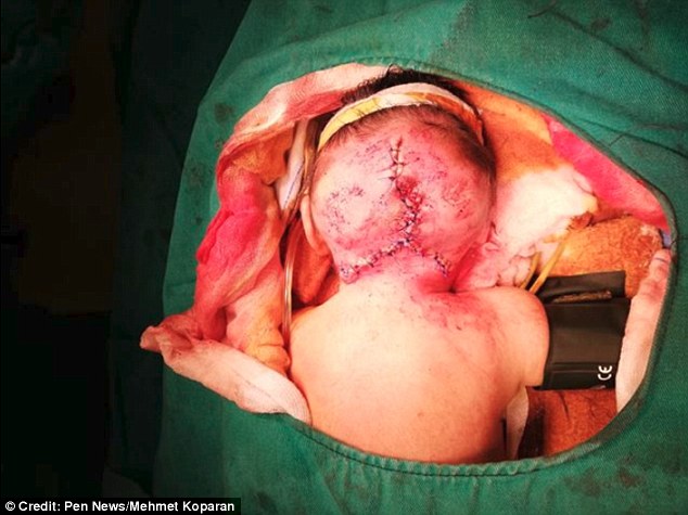 Xót xa em bé sinh ra với 2 đầu, phải phẫu thuật khi mới 3 ngày tuổi 2