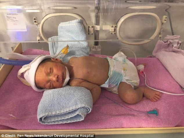 Xót xa em bé sinh ra với 2 đầu, phải phẫu thuật khi mới 3 ngày tuổi 1