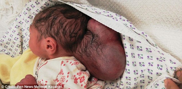 Xót xa em bé sinh ra với 2 đầu, phải phẫu thuật khi mới 3 ngày tuổi 0