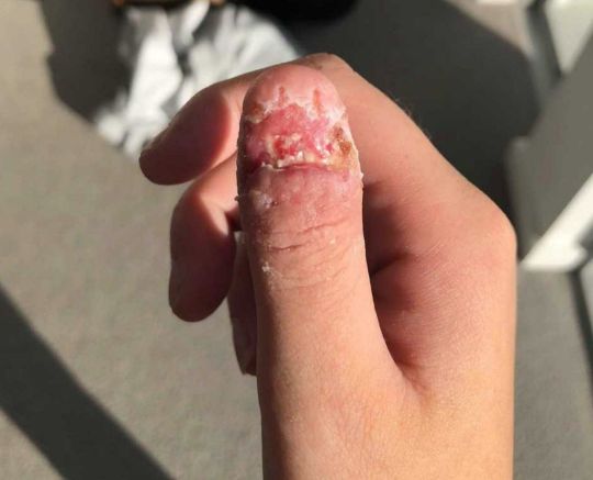 Cô gái phải cắt cụt ngón cái vì thói quen cắn móng tay hằng ngày 2