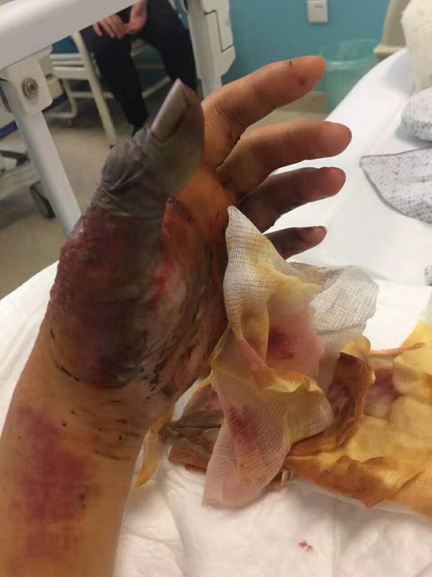 Quá trình ngón tay hoại tử phải cắt bỏ sau khi bị rắn siêu độc cắn 3