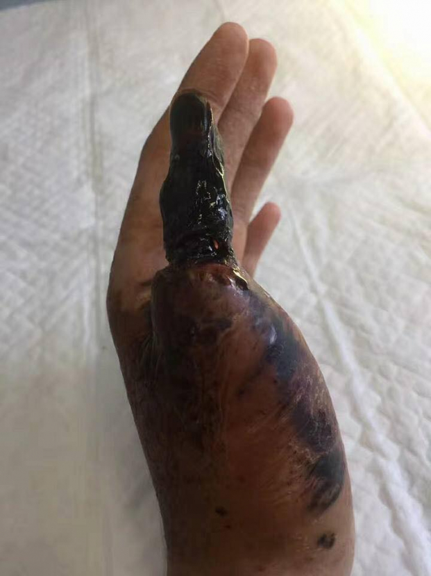 Quá trình ngón tay hoại tử phải cắt bỏ sau khi bị rắn siêu độc cắn 5