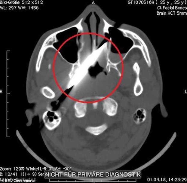 Người đàn ông bị lưỡi dao dài 10cm ghim trong đầu 4 ngày mà không biết 3