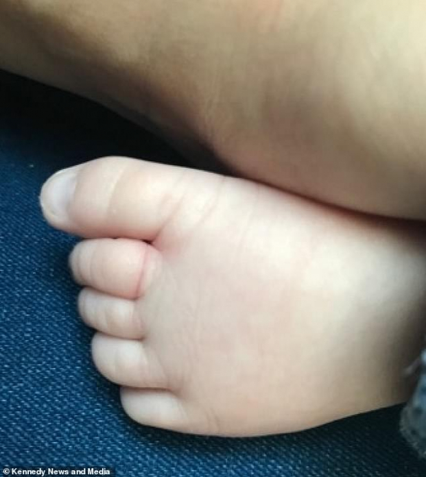 Em bé 10 tuần tuổi suýt đứt 4 ngón chân vì bị tóc rụng của mẹ cuốn chặt 2