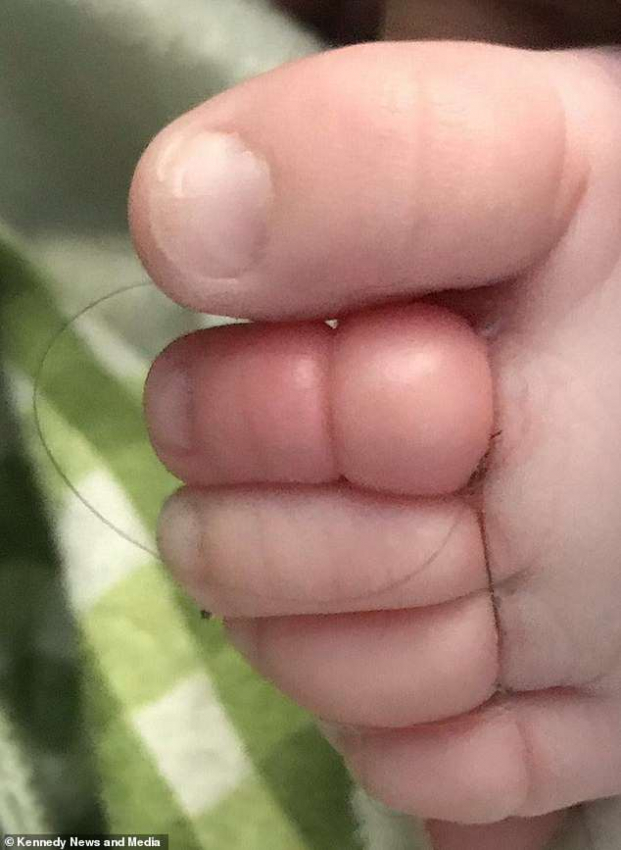 Em bé 10 tuần tuổi suýt đứt 4 ngón chân vì bị tóc rụng của mẹ cuốn chặt 0