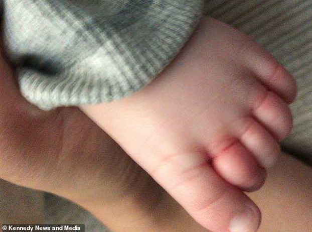 Em bé 10 tuần tuổi suýt đứt 4 ngón chân vì bị tóc rụng của mẹ cuốn chặt 1