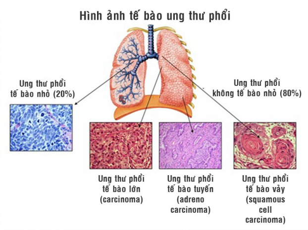   (Ảnh minh họa về hình ảnh tế bào ung thư phổi)  