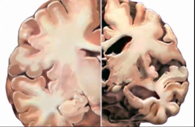 Nghiên cứu mới: Căng thẳng quá mức có thể làm teo não 1