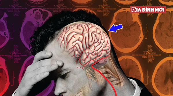   Đau đầu nửa bên trái là triệu chứng điển hình của hội chứng đau nửa đầu Migraine.  
