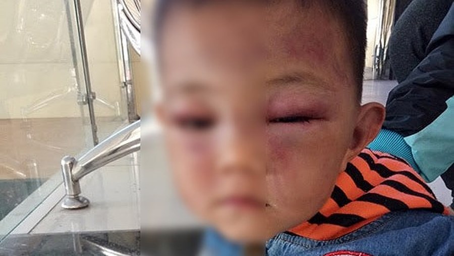 Bé trai 2 tuổi nghi bị cha dượng bạo hành đến nhập viện (Ảnh: VOV)