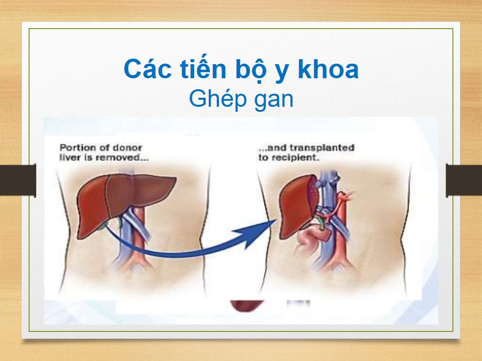 Trẻ bị teo đường mật bẩm sinh dẫn đến xơ gan phải tiến hành ghép gan để điều trị bệnh