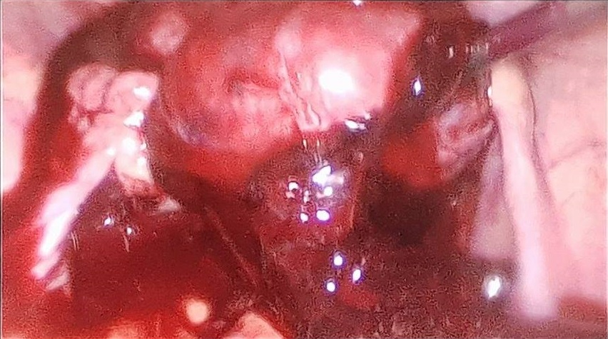 Bác sĩ tiến hành phẫu thuật cặp, cắt khối chửa ngoài tử cung để cầm máu và lấy ra khoảng 1.600 ml máu đông lẫn máu đỏ tươi ngập trong ổ bụng của bệnh nhân