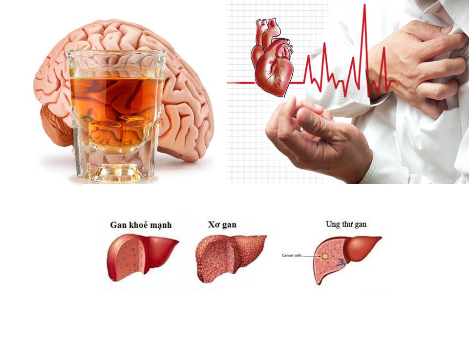 Rượu đang giết chết các tế bào não, tế bào gan, gây hại cho tim mạch của chính bạn