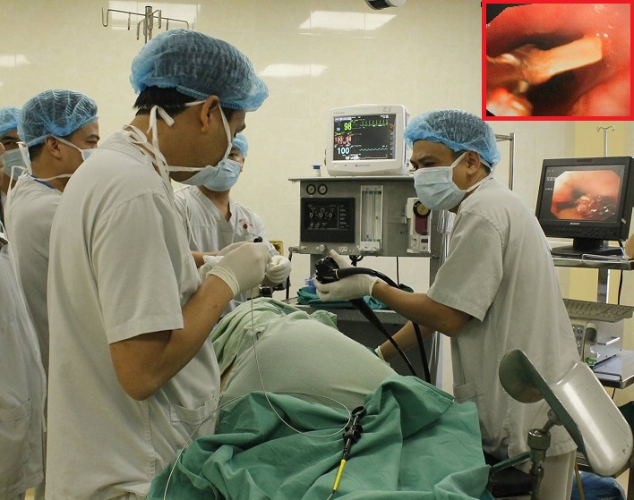 Các bác sĩ tiến hành phẫu thuật gắp xương gà mắc trong thực quản của bệnh nhân