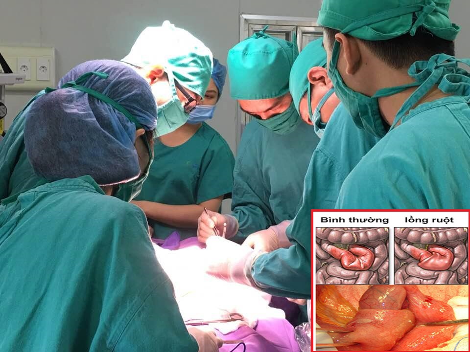 Các bác sĩ tiến hành phẫu thuật điều trị lồng ruột cho bé Đinh Thảo N.