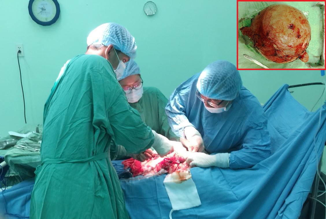 Các bác sĩ tiến hành phẫu thuật cắt bỏ khối u xơ tử cung nặng gần 6kg cho bệnh nhân