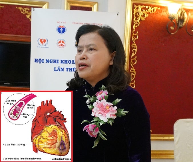 PGS.TS Nguyễn Thị Xuyên, Chủ tịch Tổng hội Y học Việt Nam cho biết, tỷ lệ mắc bệnh tim mạch, đột quỵ ngày càng gia tăng ở Việt Nam