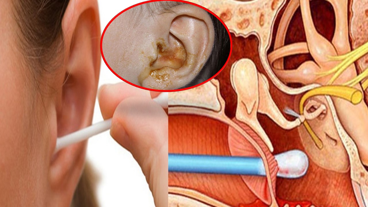 Thường xuyên ngoáy tai sẽ gây tổn thương da ống tai, tạo điều kiện thuận lợi cho các vi khuẩn có thể xâm nhập xuống dưới lớp biểu bì gây viêm ống tai ngoài