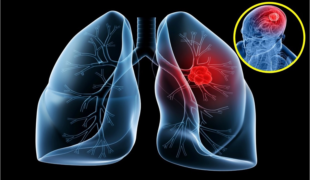 Có trên 30% bệnh nhân ung thư phổi bị di căn lên não