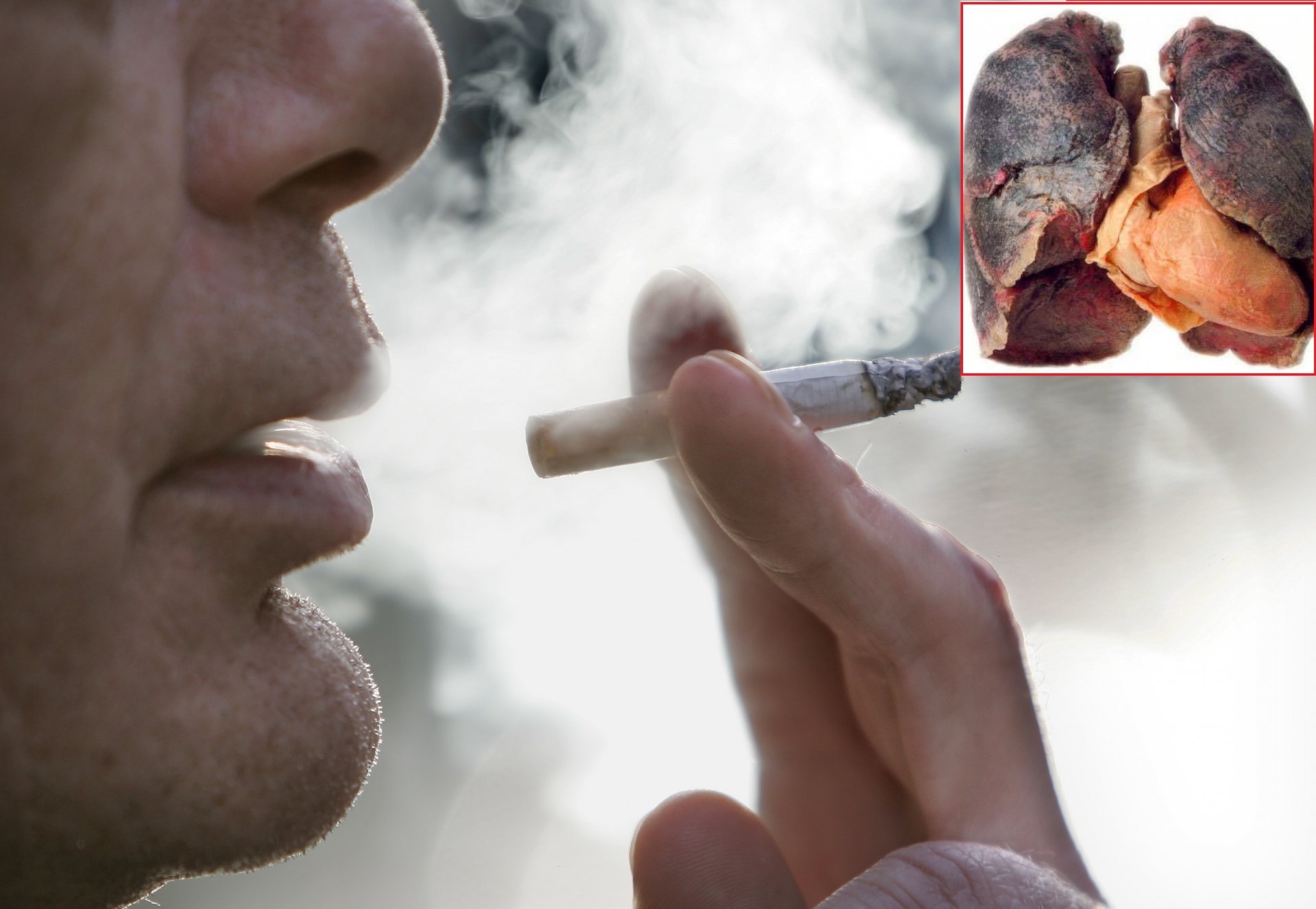 Hút thuốc lá là nguyên nhân hay gặp dẫn đến ung thư phổi