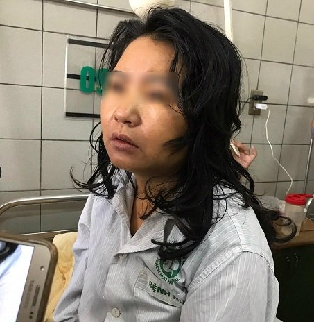Bệnh nhân Nguyễn Thúy Ng. hiện vẫn đang được các bác sĩ Bệnh viện Bạch Mai tích cực cứu chữa