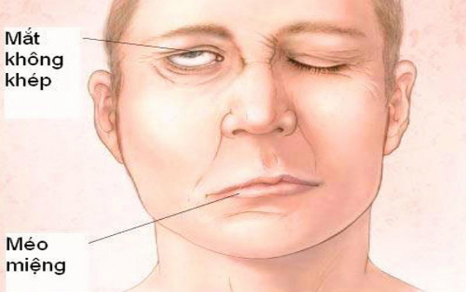Liệt nửa mặt, méo miệng, mắt không khép là biểu hiện chính của bệnh liệt dây thần kinh số 7