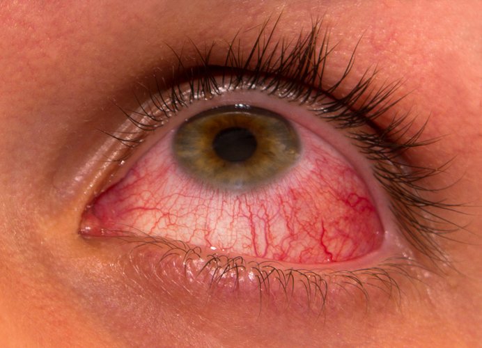 Khi xuất hiện triệu chứng ngứa mắt, đỏ mắt cần đi thăm khám sớm tại các cơ sở y tế chuyên khoa