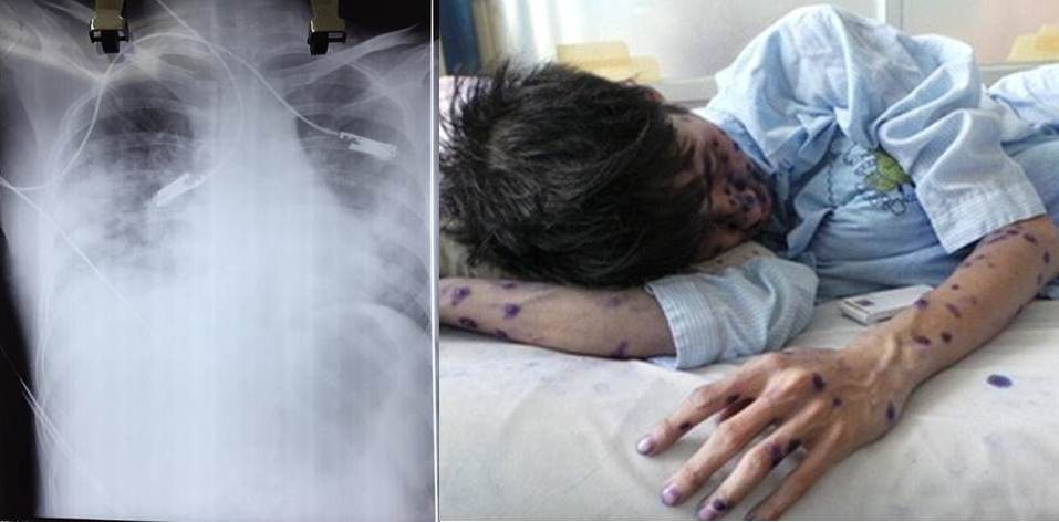 Người bị bệnh thủy đậu trên nền bị các bệnh suy giảm miễn dịch thì có thể có biến chứng viêm phổi nặng