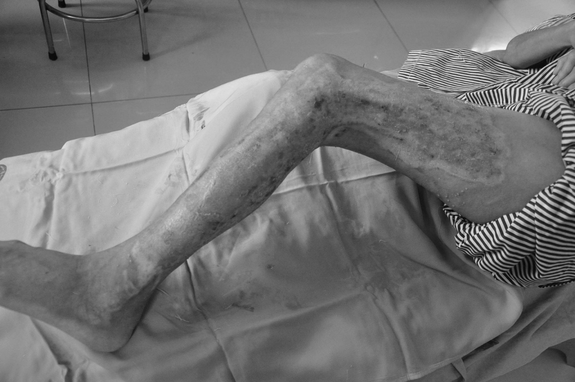 Bệnh nhân bị bỏng nặng do ngâm chân nước nóng, đắp lá cây chữa bệnh đái tháo đường