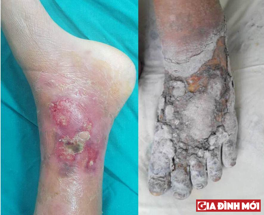 Nhiều bệnh nhân bị hoại tử phải cắt cụt chân vì đắp thuốc Đông y không rõ nguồn gốc
