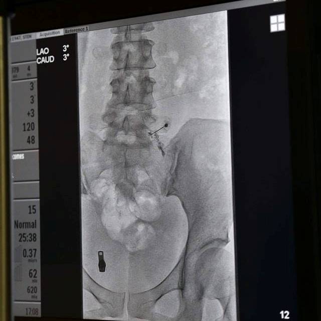 Hình phim chụp X quang cột sống của bệnh nhân